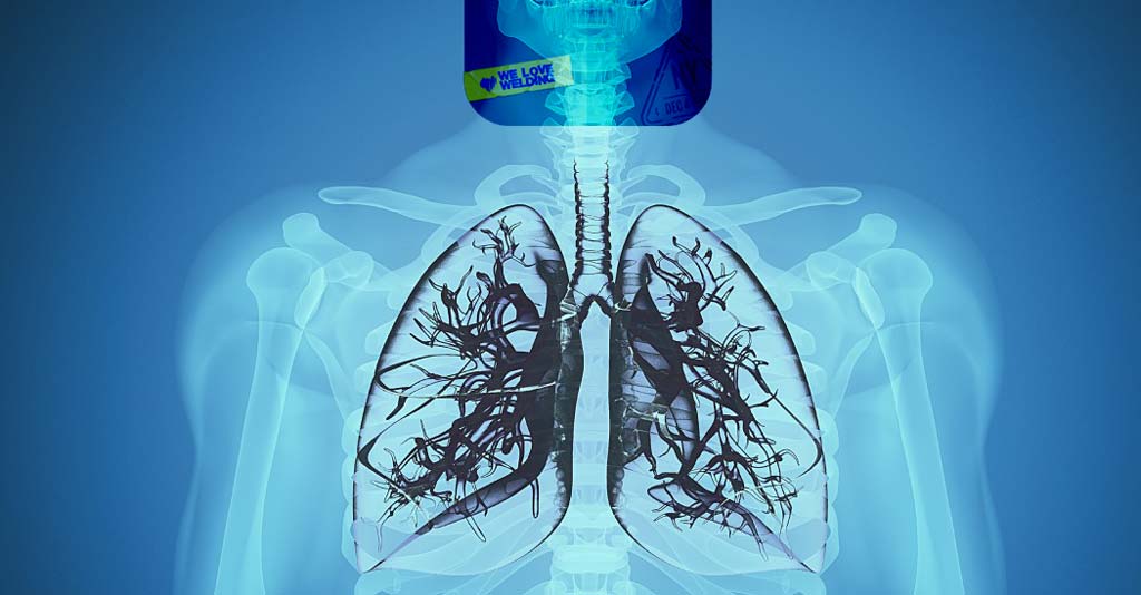 The Most Common Welder Diseases and Their Symptoms